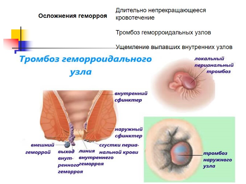 Осложнения геморроя Длительно непрекращающееся кровотечение  Тромбоз геморроидальных узлов  Ущемление выпавших внутренних узлов